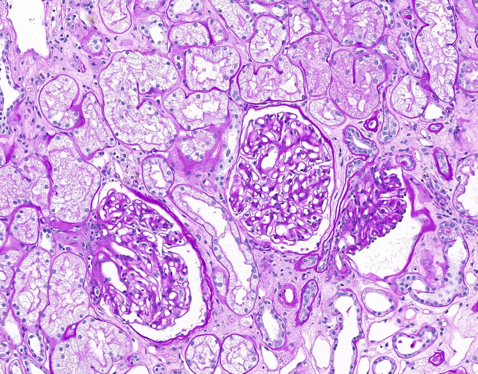 Magnified kidney biopsy showing three rounded glomeruli among surrounding tubules.